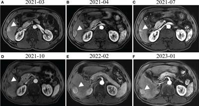 Case Report: Complete response after tislelizumab treatment in a hepatocellular carcinoma patient with abdominal lymph node metastasis